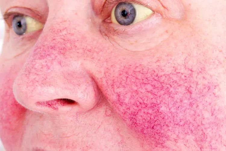 लिव्हर खराब होण्याची लक्षणे